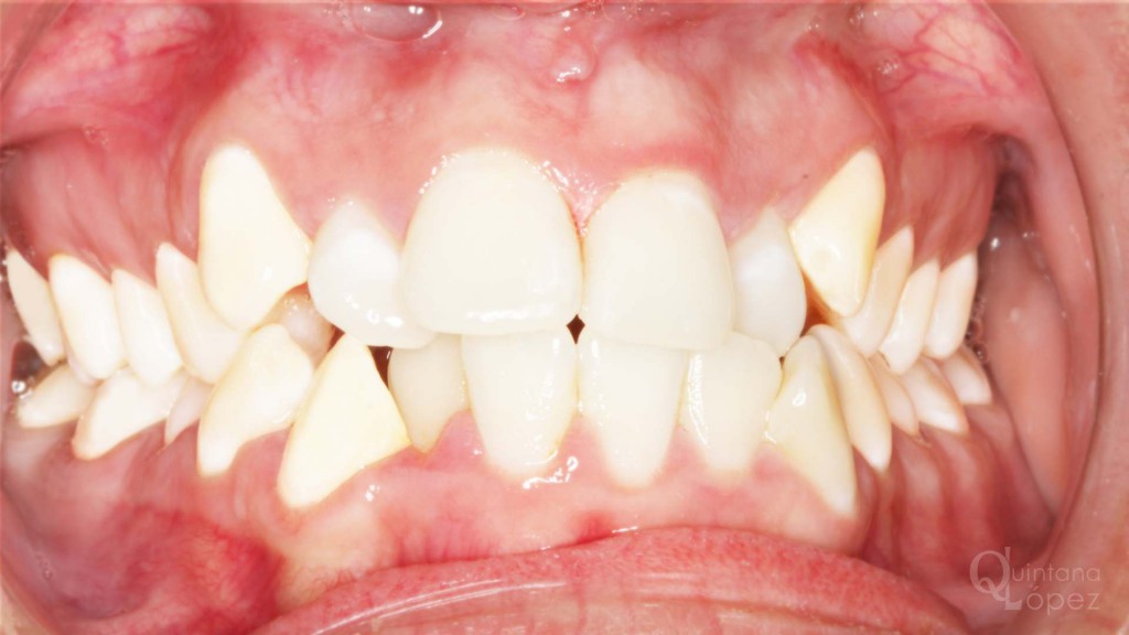 ortodoncia caso clínico 9 antes