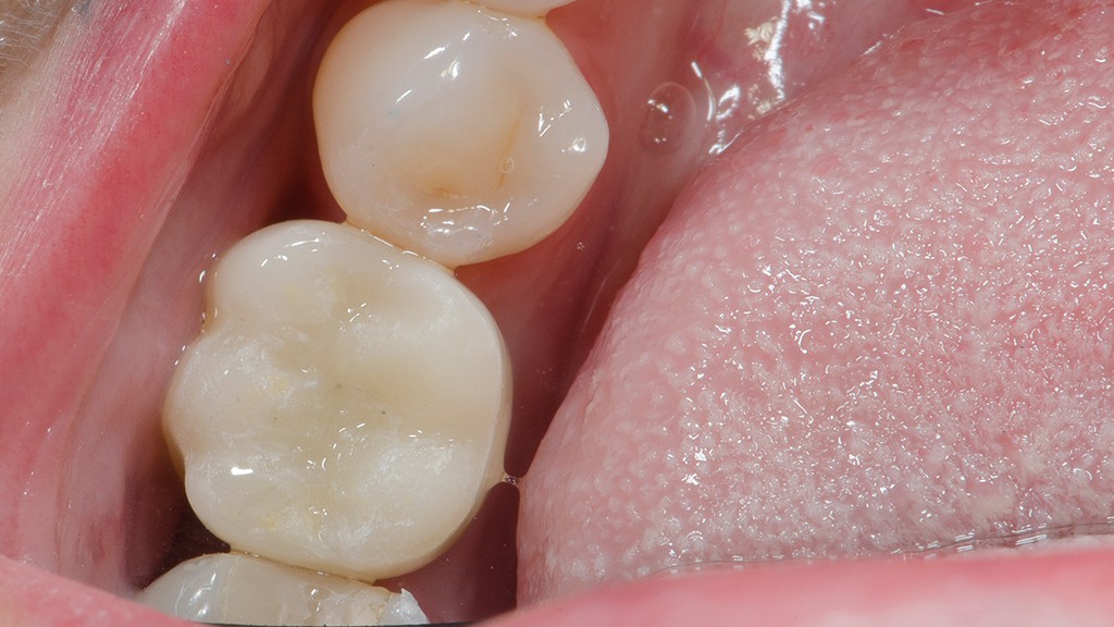 Implante diferido y conformacion gingival despues