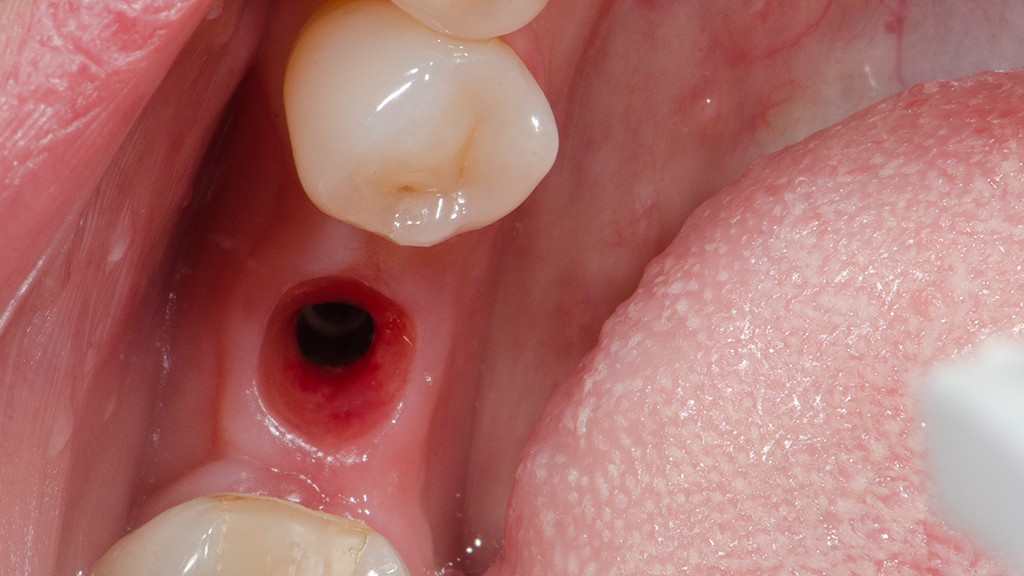 Implante diferido y conformacion gingival Antes