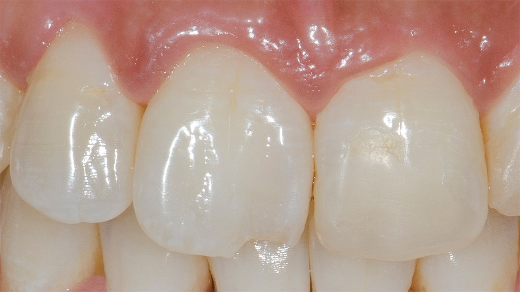 fractura borde incisal antes