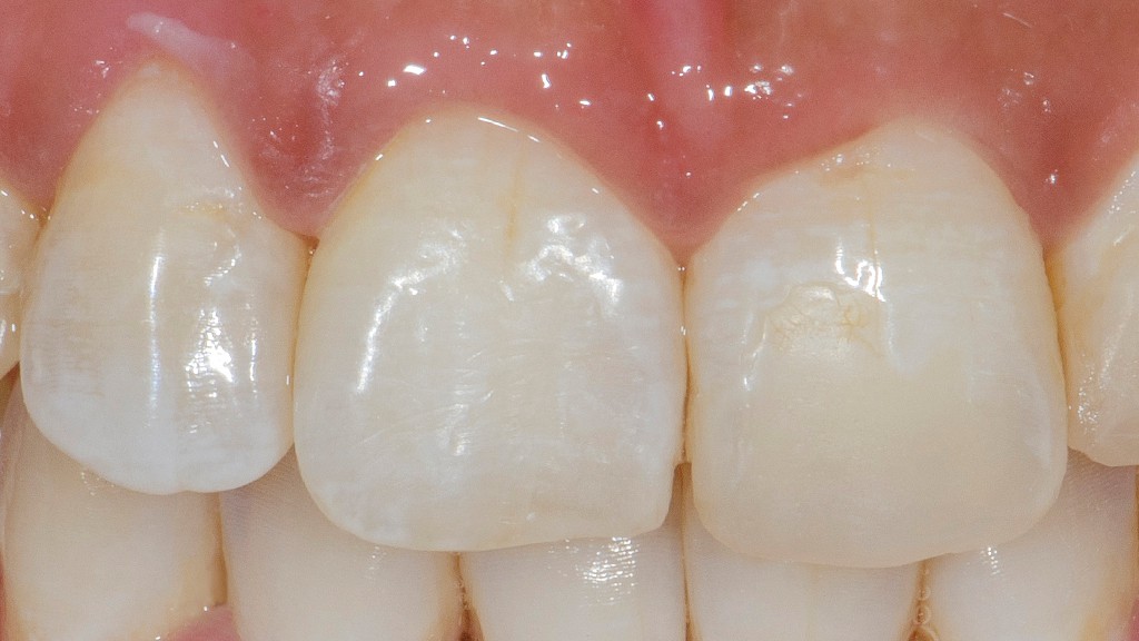 fractura borde incisal después