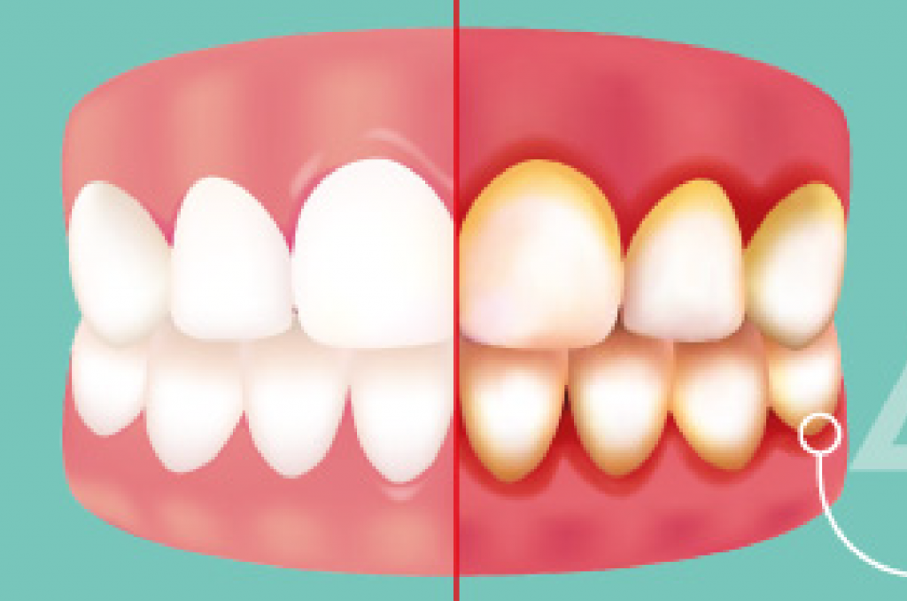 Gingivitis grafico