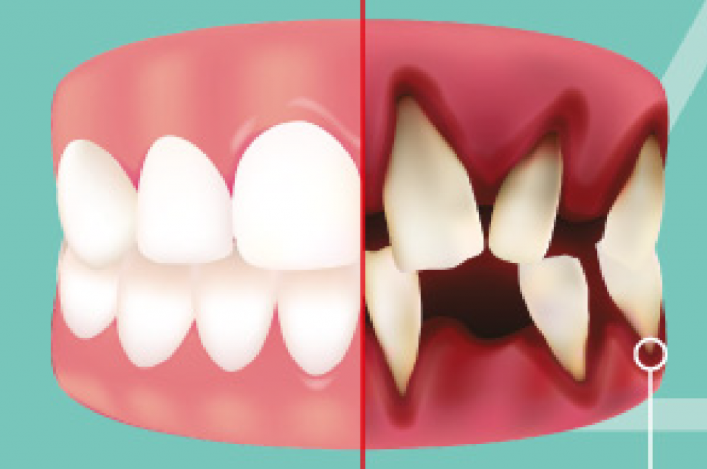 periodontitis