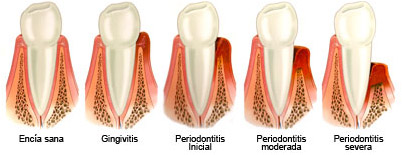 periodontitis evolucion