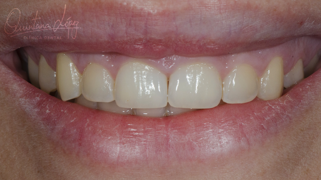 Previo Caso Sonrisa Gingival