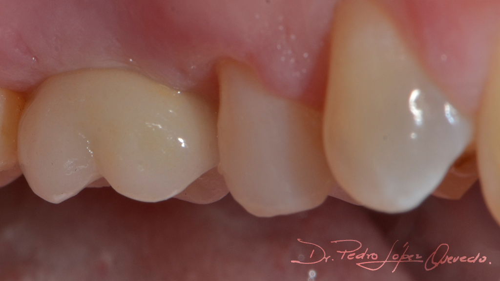 molar superior derecho post