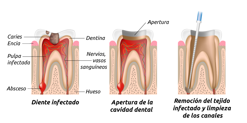 Tratamiento endodontico