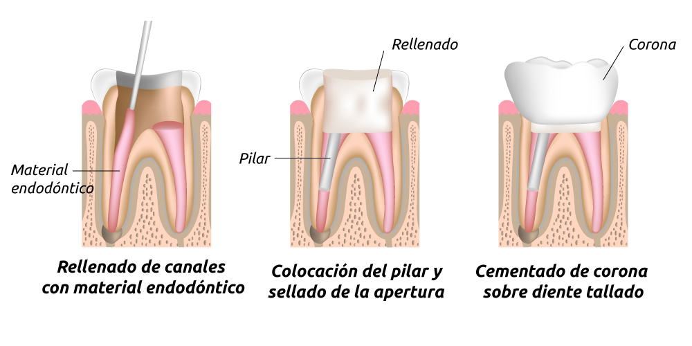 Tratamiento de conductos 