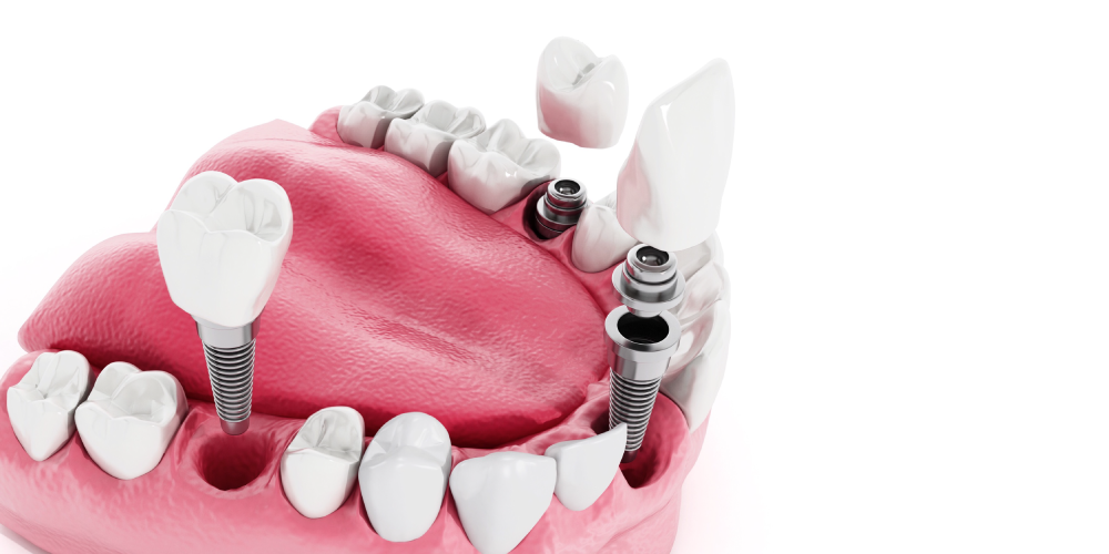 implantes dentales necrosados