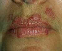 lesiones en los labios por lupus