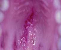 lesion de paladar por lupus
