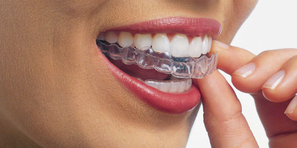 ortodoncia invisible invisalign