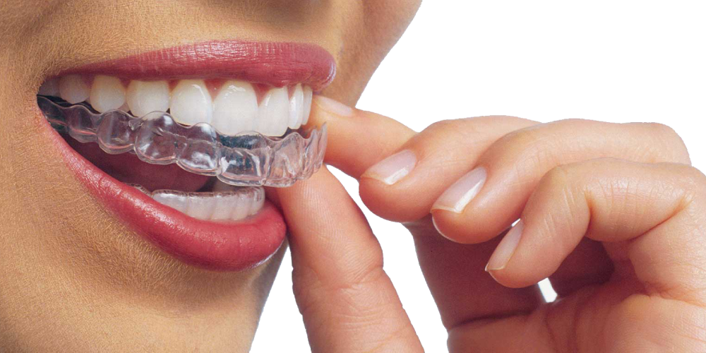 Invisalign