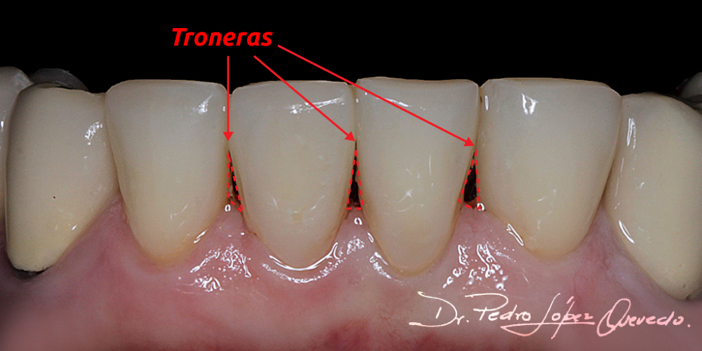 troneras