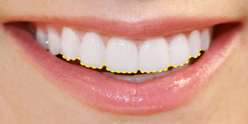 Delimitación contorneado dental estetico