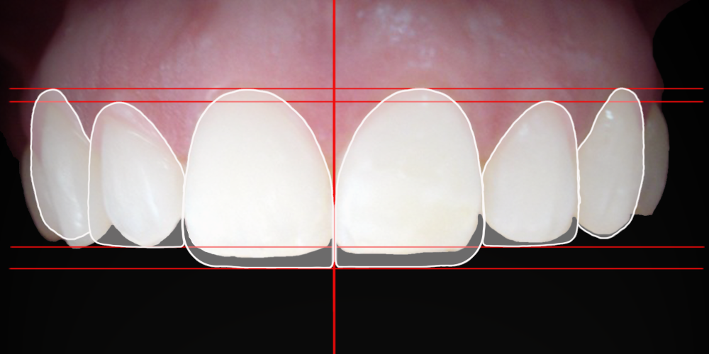 Contorneado Dental Estético