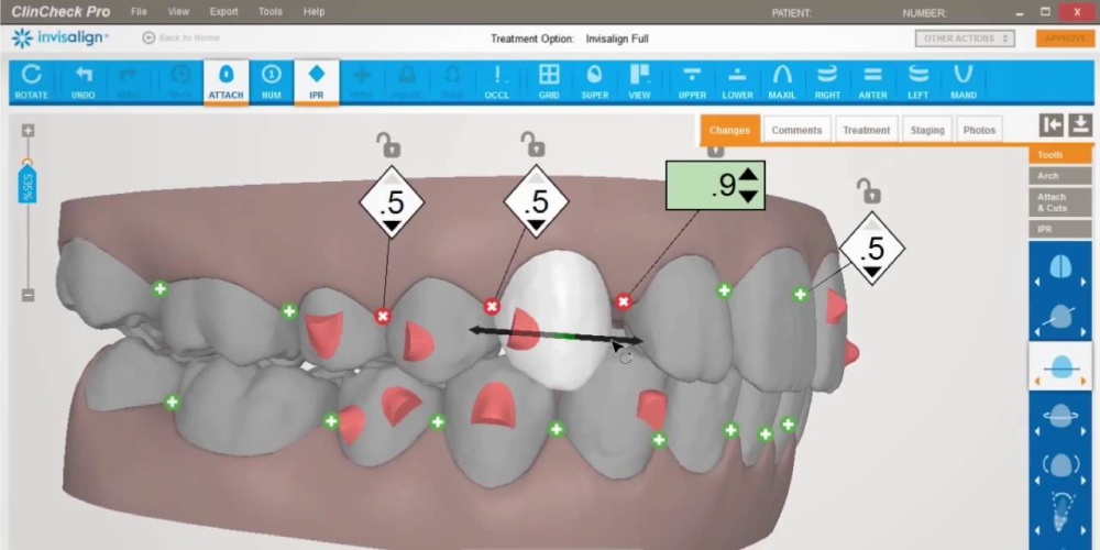 Software de Invisalign ClinCheck